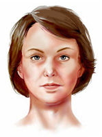 face lift cost UK cheap face lift abroad