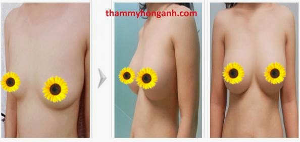 [Image: nang-nguc-noi-soi-an-toan-khong-2.jpg]