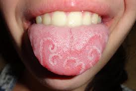 Oral corticosteroids definition