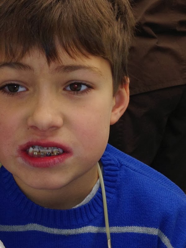 CHD Blog www.One in 1 Hundred. Top Braces...at 8 years old!