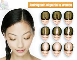 Cara Menyuburkan Rambut Punca Dan Cara Mengatasi Rambut Gugur Botak Dan Nipis