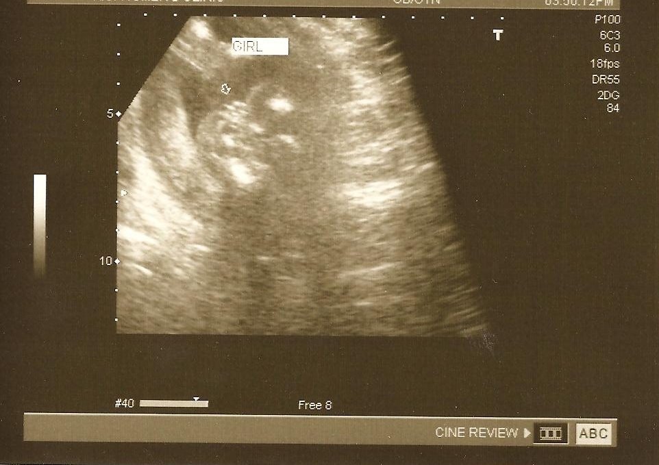 girl sonogram girl sonogram