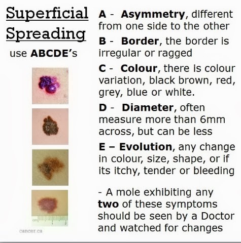 Melanoma - What to Look For!!