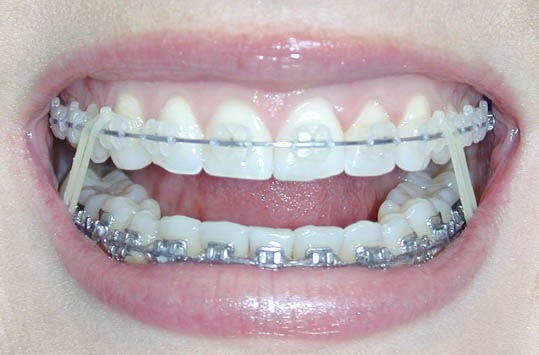 braces rubber bands orthodontics elastics