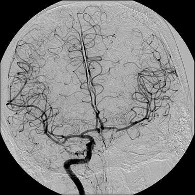 Resultado de imagem para angiografia
