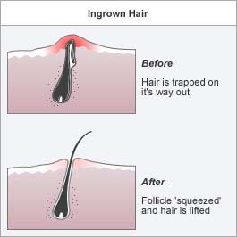 Hair Dresser 2011 Ingrown Pubic Hair Six Tips