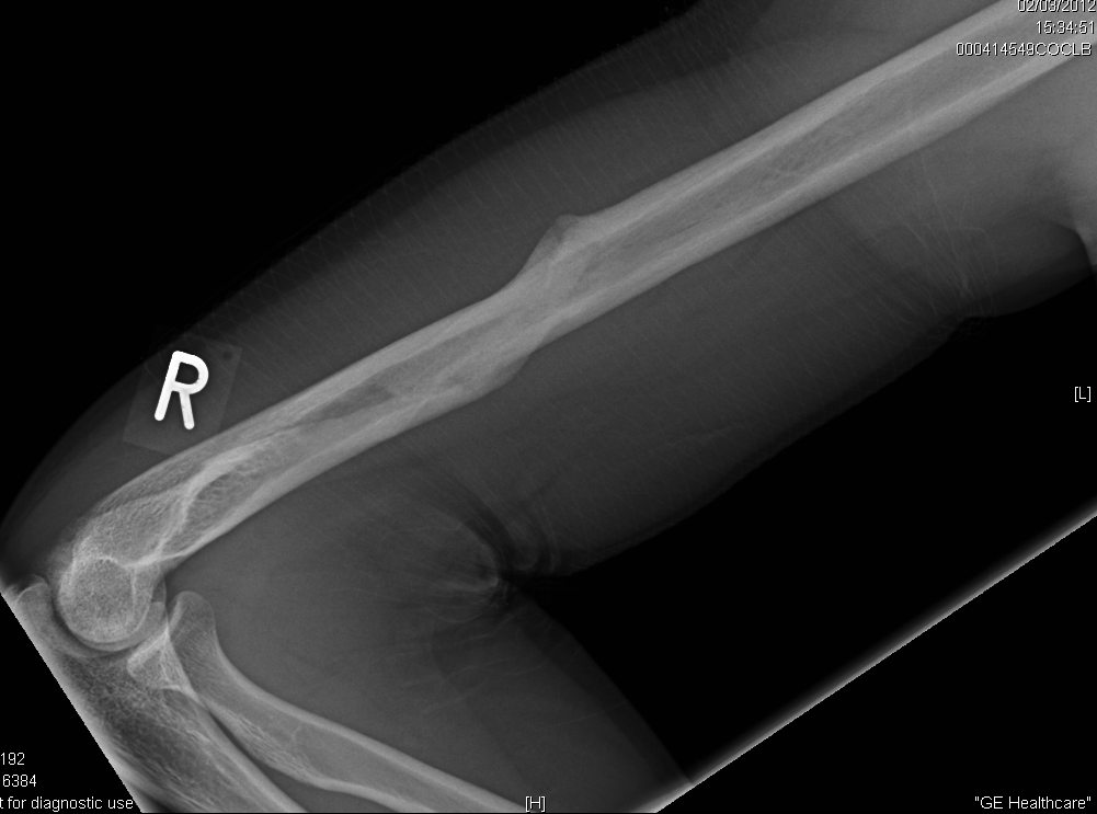 Humerus Spiral Fracture Recovery