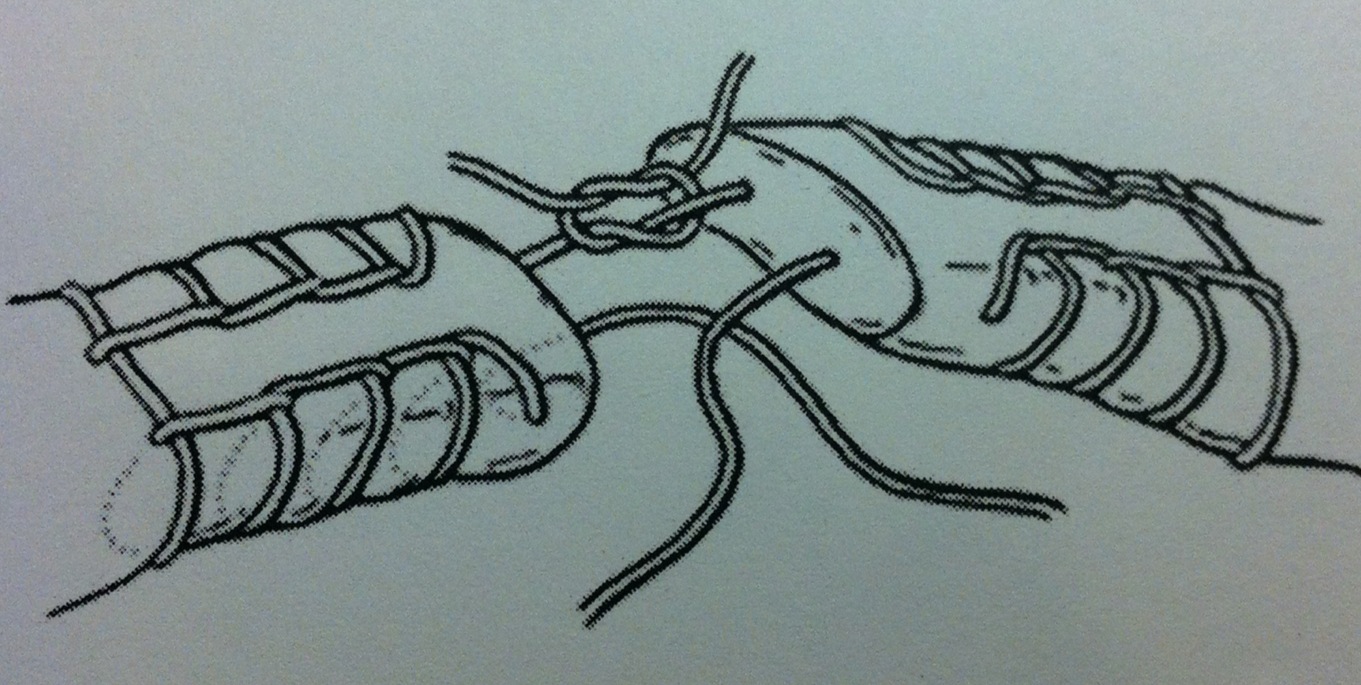 Palmer Foot and Ankle Achilles Tendon Repair Techniques