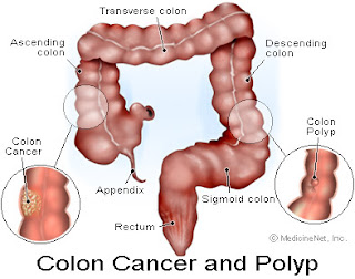 schema du cancer de colon image