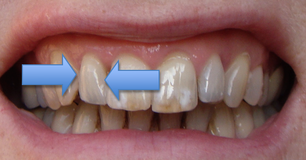 sharp wire brace braces