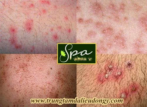 Thuoc chua va cach dieu tri benh viem nang long THUỐC THẢO DƯỢC ĐÔNG Y CHỮA TRỊ BỆNH VIÊM NANG LÔNG