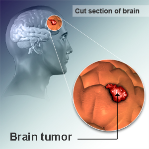 brain tumor cancer malignant tumors symptoms stages type affected body medical treatment tumour risks adult mass some parts whats benign