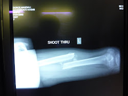 fracture healing with 5 cm shortening