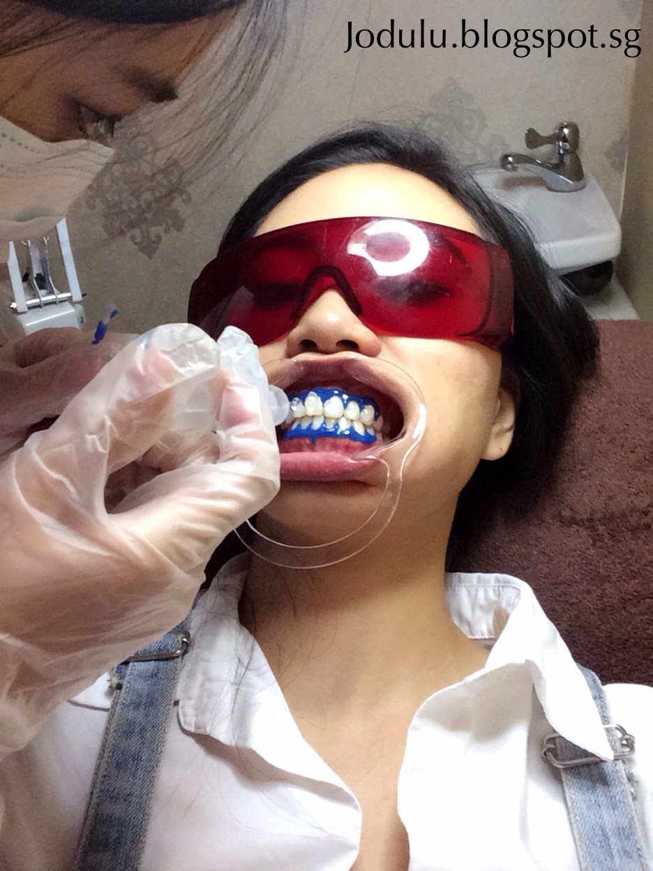 Jodulu The Mermaid Lifestyle & Beauty Blog Lush Aesthetics LED Teeth