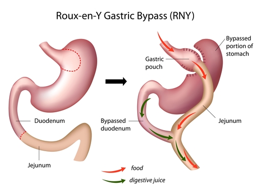 Image of: type of gastric bypass surgery performed in Oklahoma City by Summit Medical Center