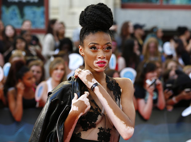 chantelle young, vitiligo, top model, american next top model, maladie de la peau