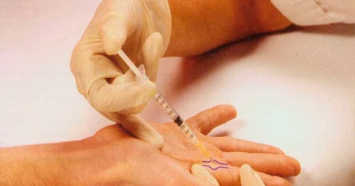 Flexor Tendon Nodule Injection ~ Nursing