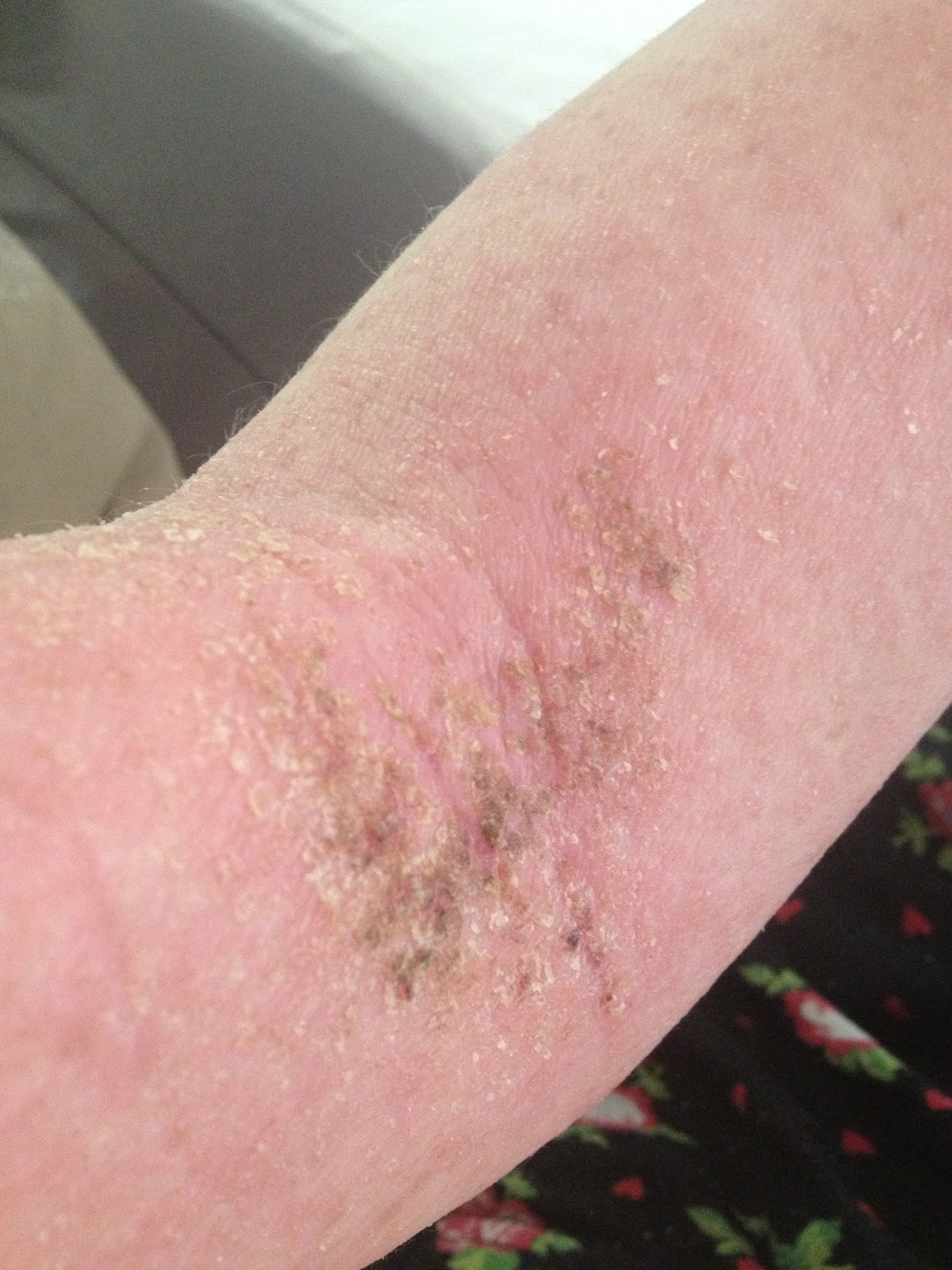 Cara's blog for all things Topical Steroid Withdrawal The many