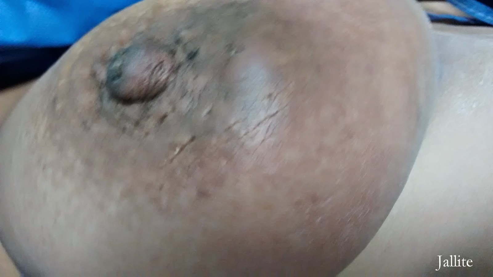 wacth free porn online padgets disease of breast picture