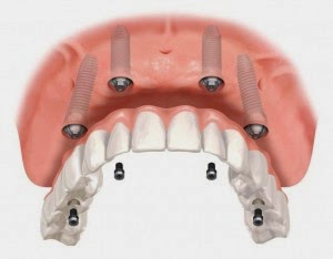 douleur d'un implant dentaire