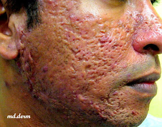 Acne breakout after steroids