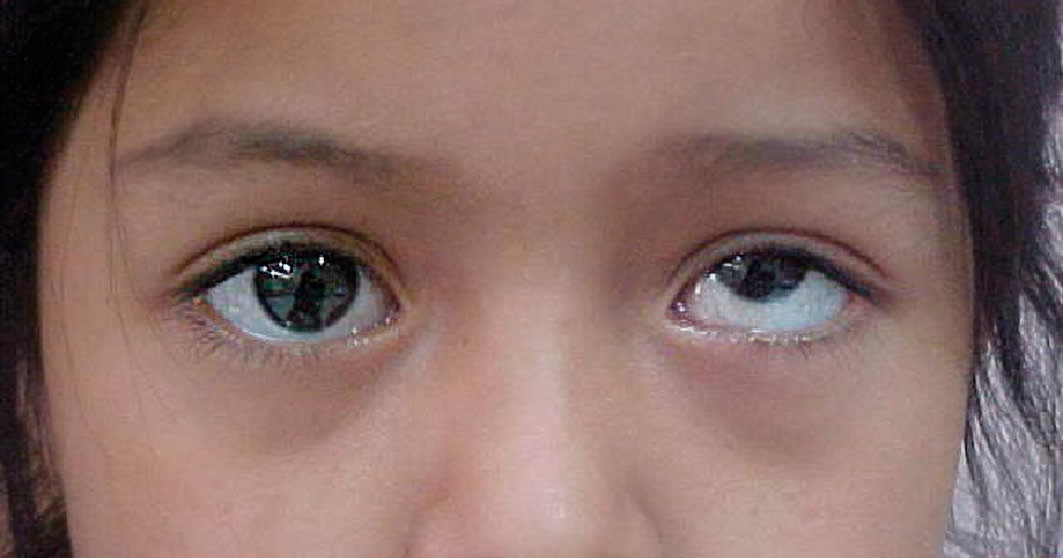 Eye 2 Eye Optometrists Vertical Strabismus Definition,Types