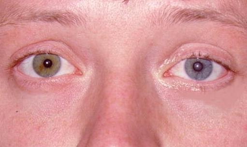 Medbizarre: Heterochromia Iridium