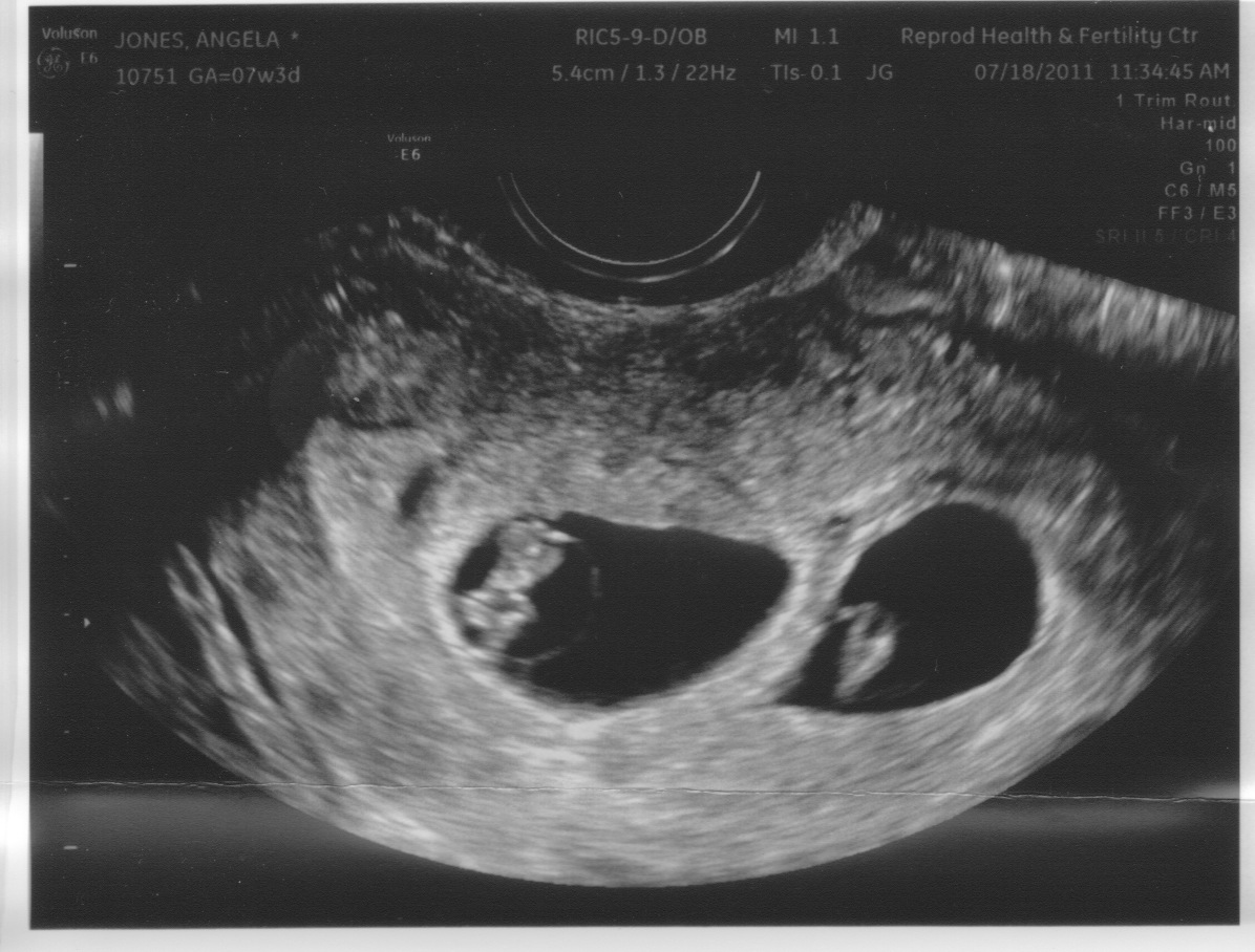down syndrome 18 week ultrasound 4d down syndrome 18 week ultrasound 4d