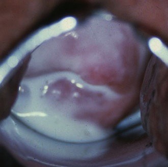 White vaginal discharge during sex pic 67