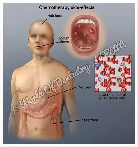 chemotherapy teeth side effects