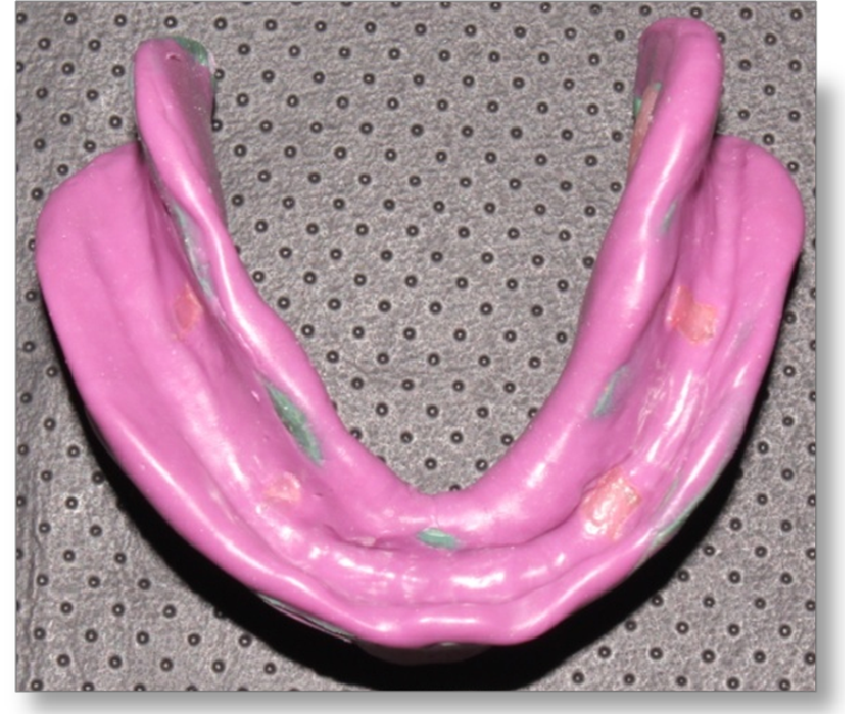 Step by step Guide for Understanding the Prosthodontics Complete