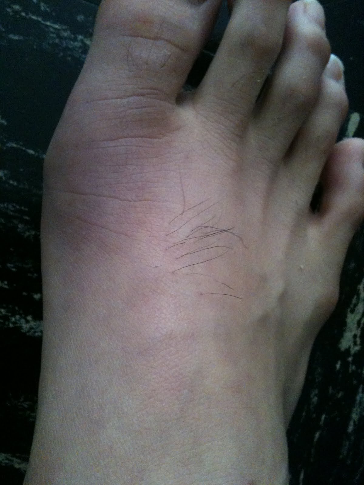 Gout Flare Up