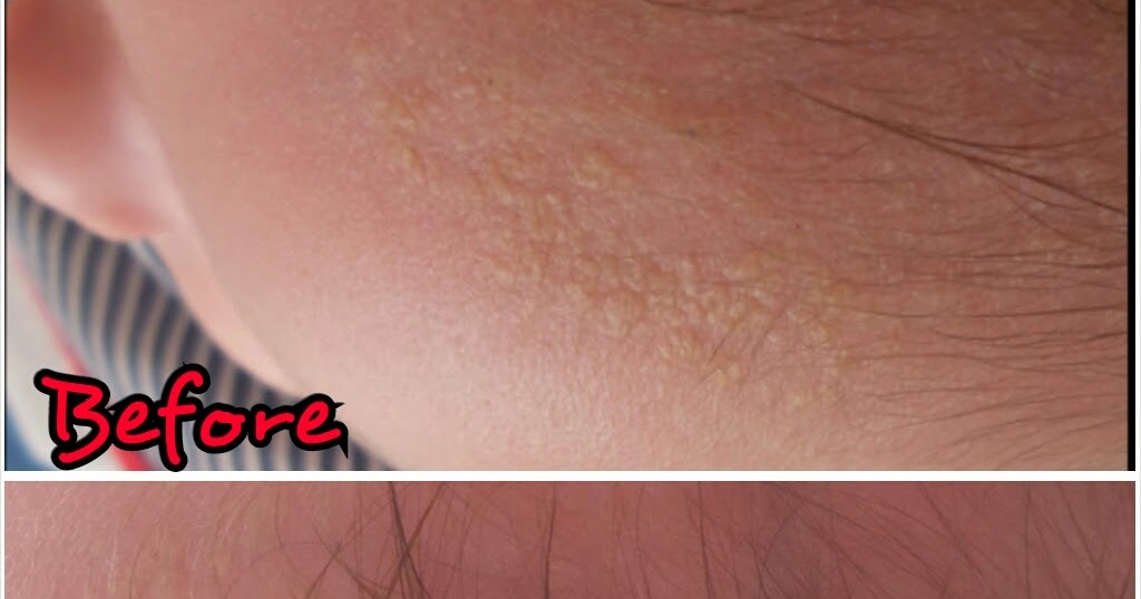 Symptoms and Treatment of Cradle Cap Coming from Carson's Mummy