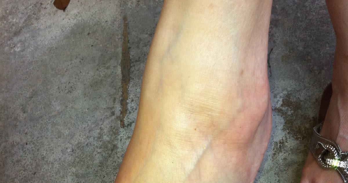 Health for everyone Bruised veins and arteries on foot