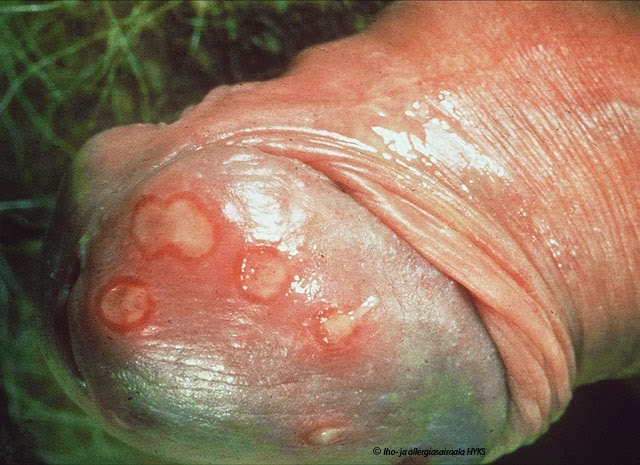 Penyakit Herpes Pada Penis
