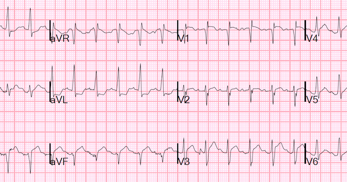 Dr. Smith's ECG Blog Sudden Severe SOB and ST Segment Elevation What