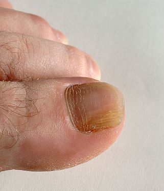 In some instances Toenail Fungus can be hereditary