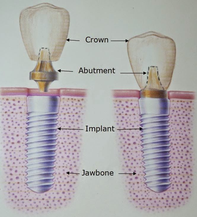 Implants