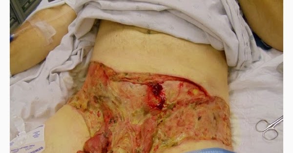 Gangrene gas causes symptoms diagnosis Gangrene