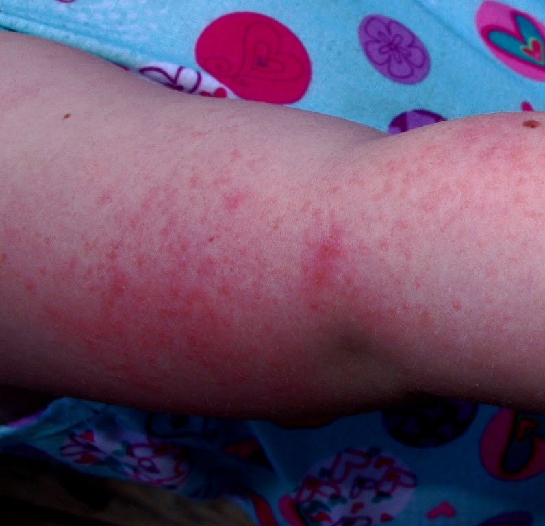 LIFE Marriage, Kids, Dogs, Chickens, and ROHHAD Syndrome Allergic to