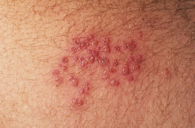 Complete Understanding of What is Genital Herpes