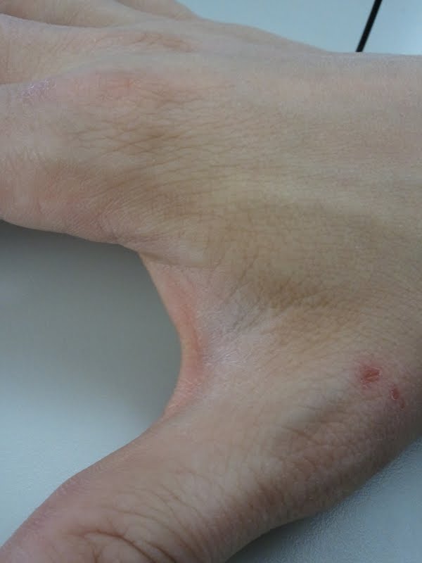 diamox bula anvisa diamox how does it work