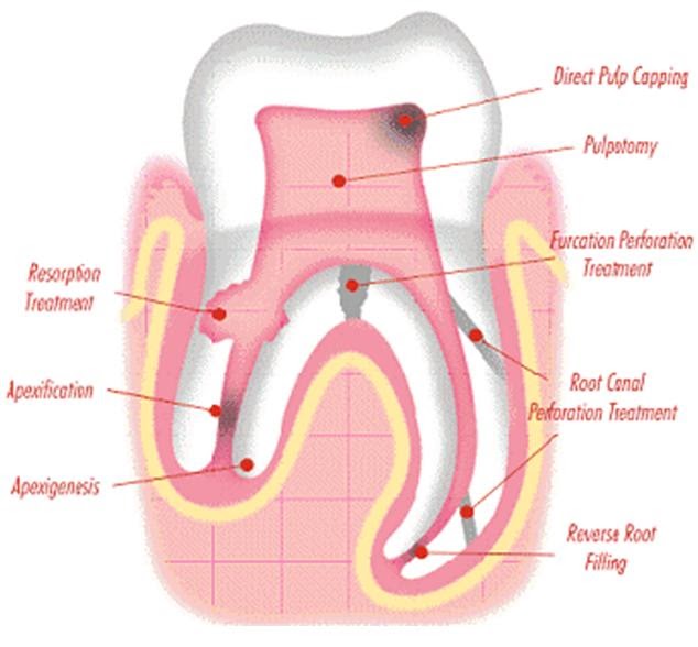 WizDent Clinical Application OF MTA