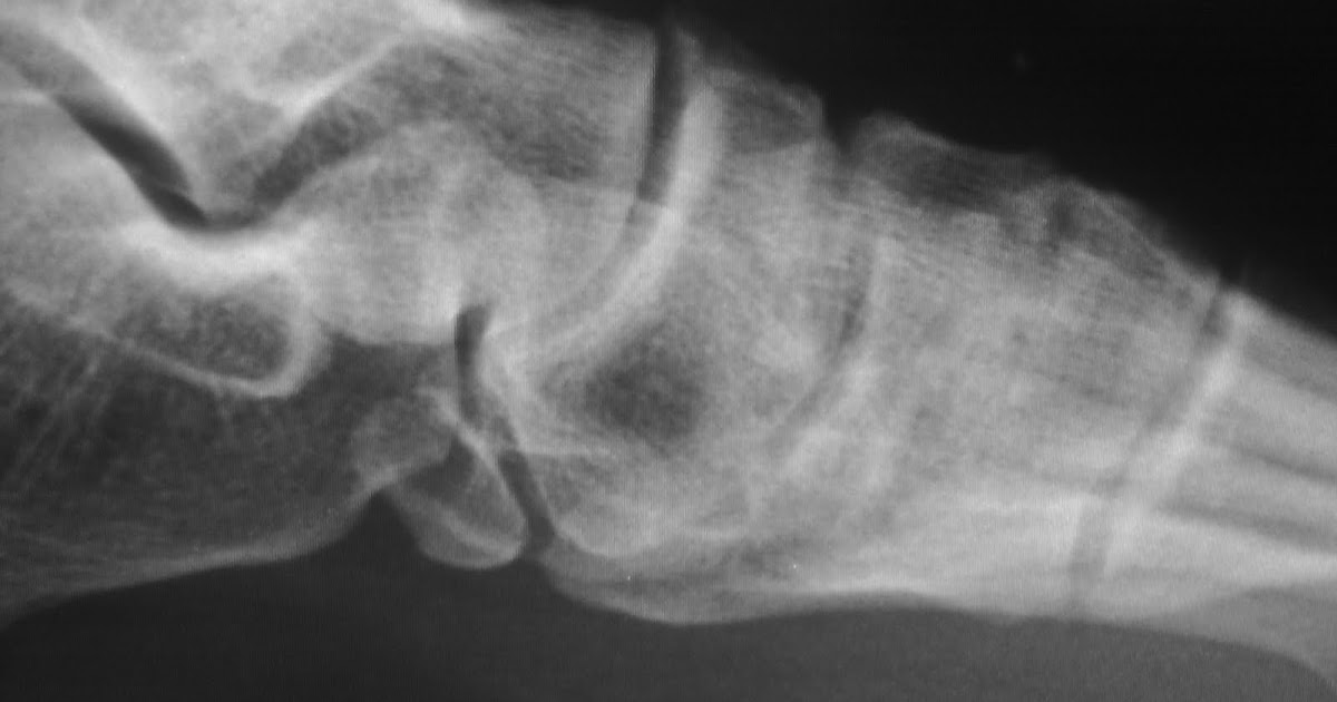 Daily Dose Fusion of accessory navicular
