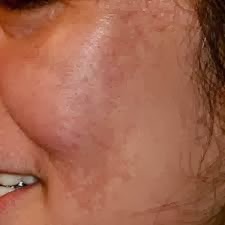 Remove face acne, blemishes &amp; dark skin spots