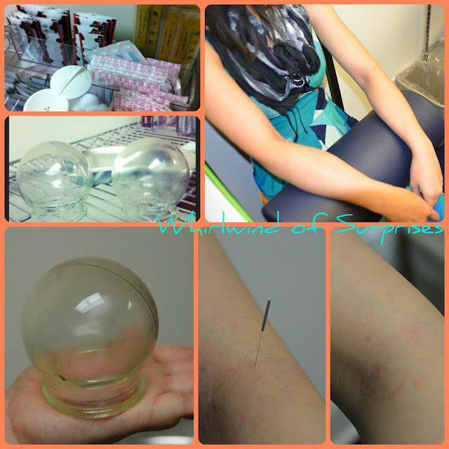 Accupuncture, Cupping, Holistic Health
