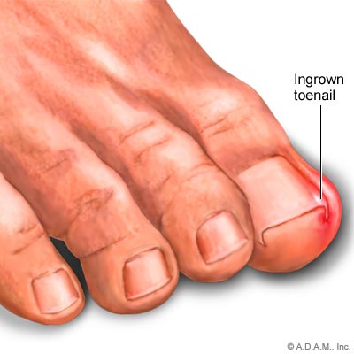 ingrown little toenail