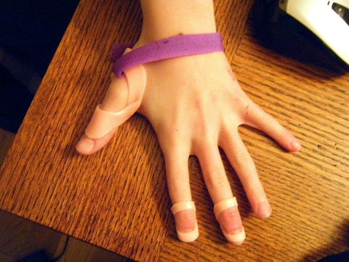 Ehlers Danlos Syndrome Here Ring Splints