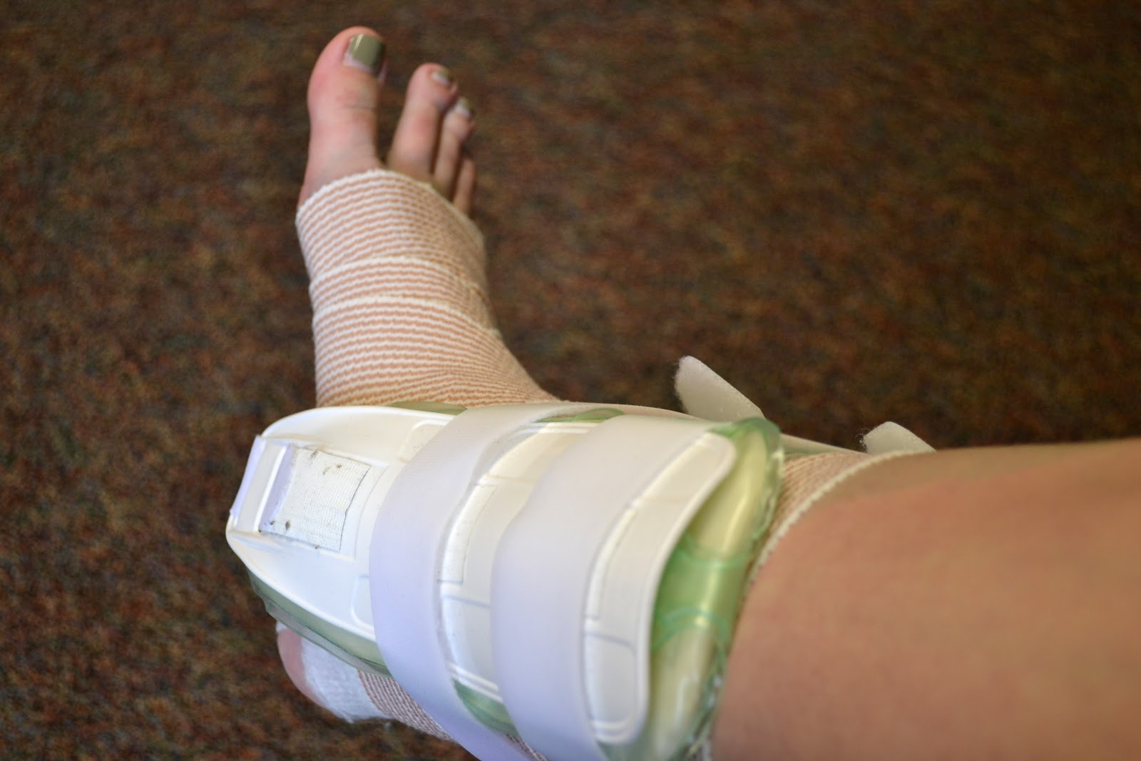 My Broken Ankle Screw Removal