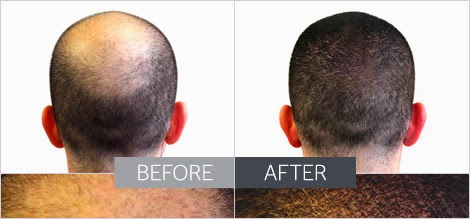 Infinity Hair Fibers Best Hair Concealer Thinning Hair